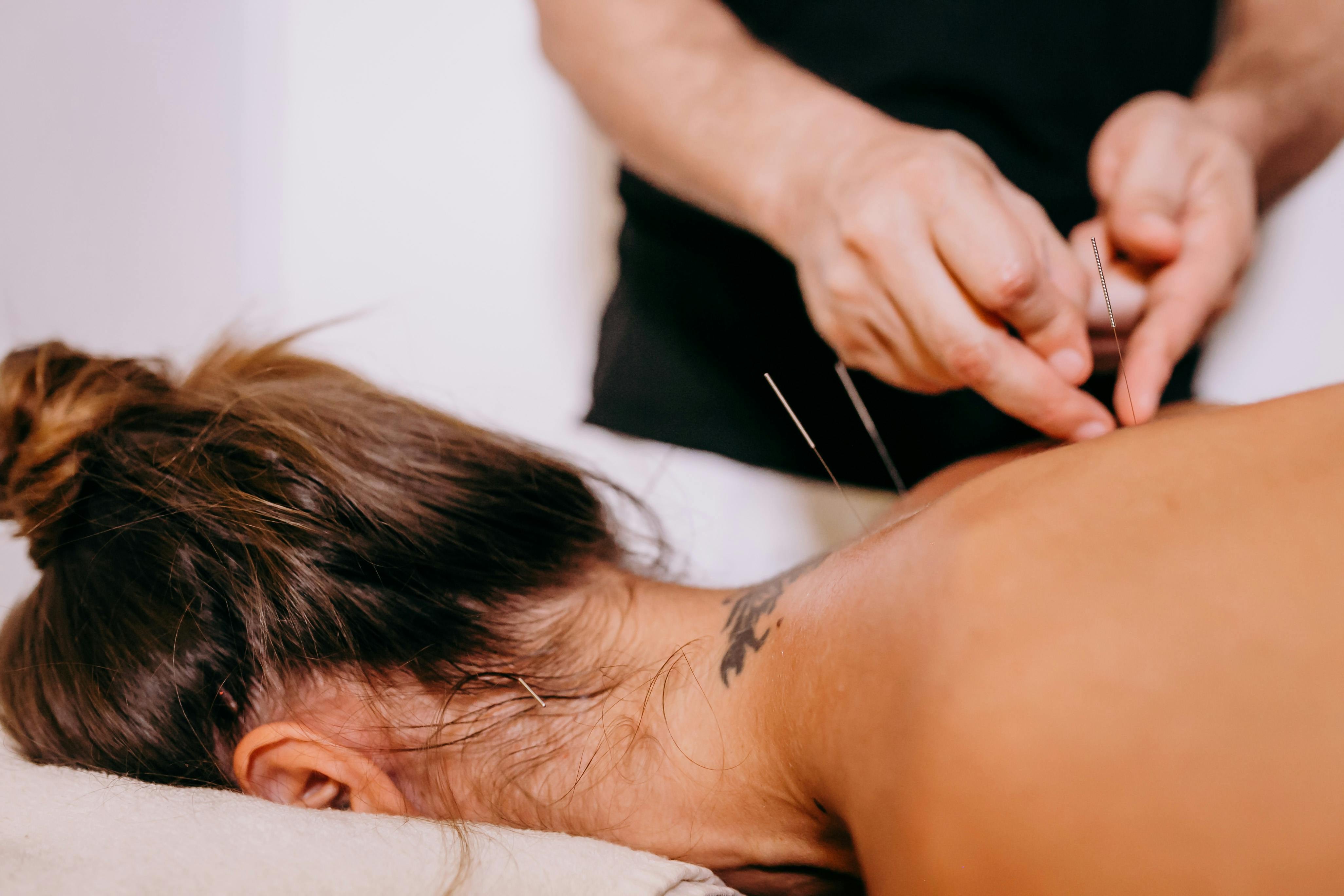 Acupuncture for Upper Back Tension and Headaches